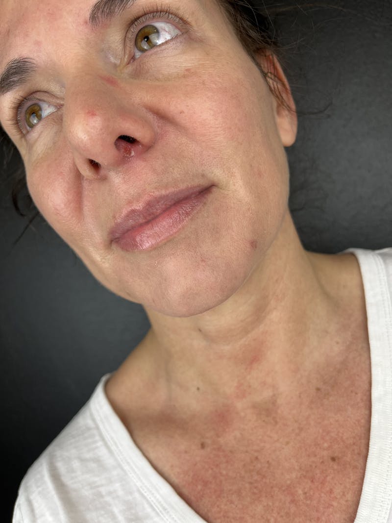 Lip Filler Before & After Gallery - Patient 862820 - Image 1