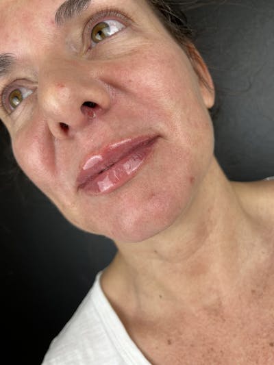 Lip Filler Before & After Gallery - Patient 862820 - Image 2