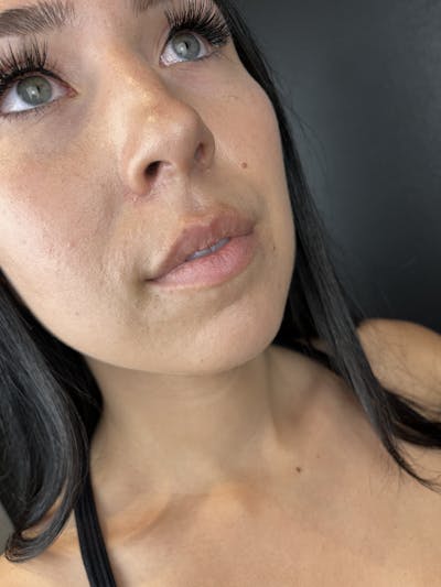 Lip Filler Before & After Gallery - Patient 333938 - Image 1