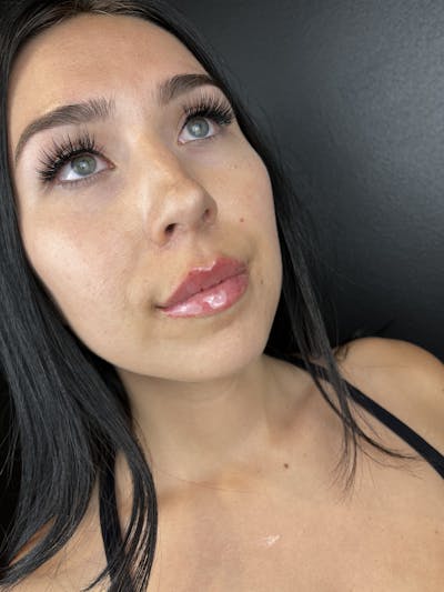 Lip Filler Before & After Gallery - Patient 333938 - Image 2