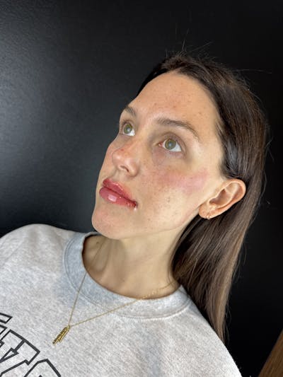 Lip Filler Before & After Gallery - Patient 217114 - Image 2