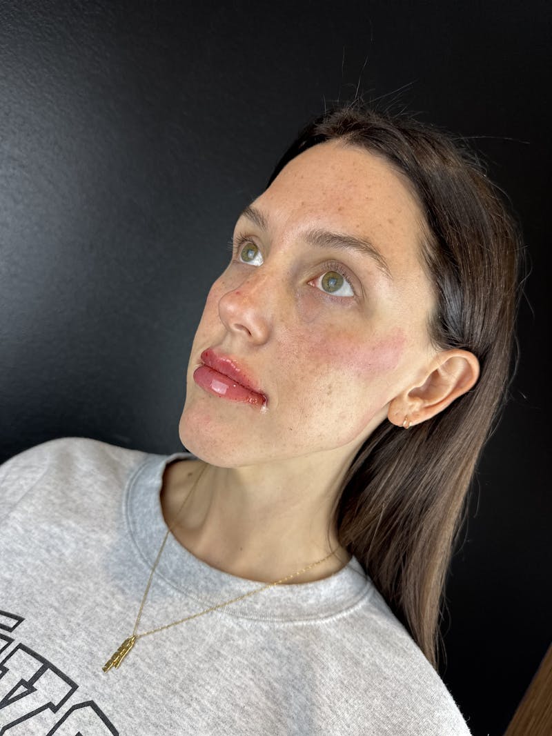 Lip Filler Before & After Gallery - Patient 217114 - Image 2