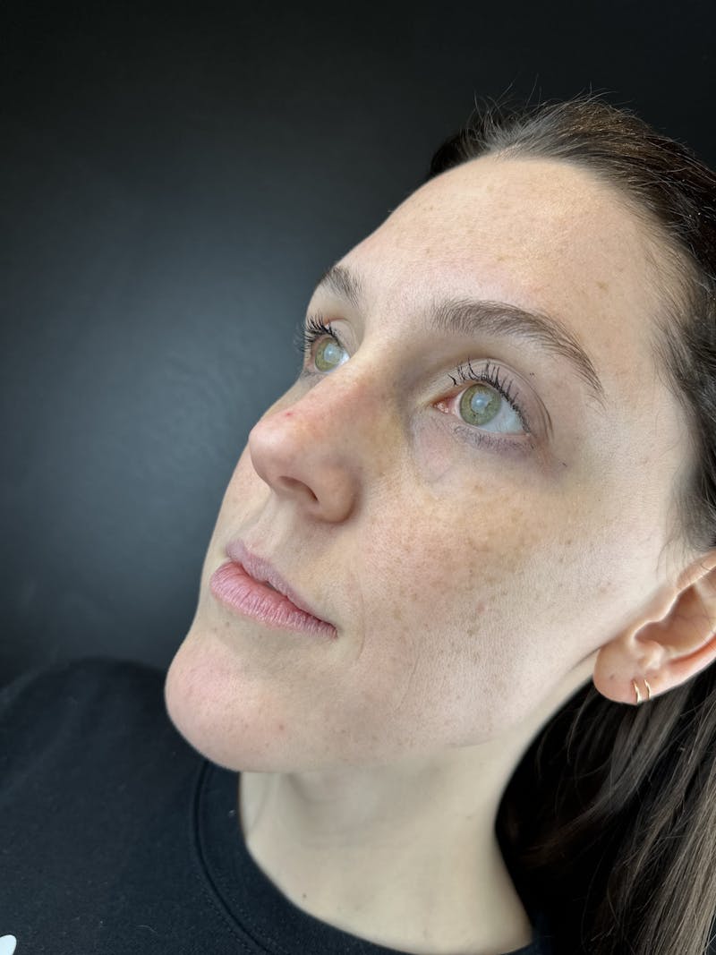 Lip Filler Before & After Gallery - Patient 217114 - Image 1