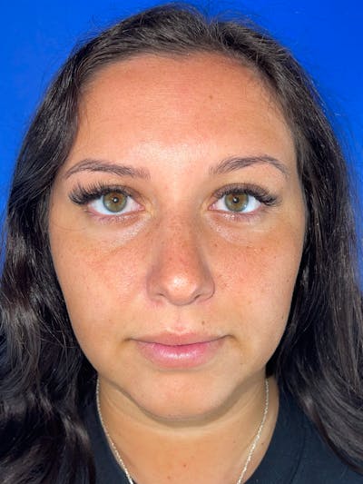 Lip Filler Before & After Gallery - Patient 254539 - Image 1