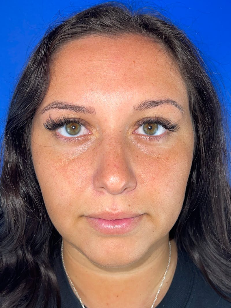 Lip Filler Before & After Gallery - Patient 254539 - Image 1