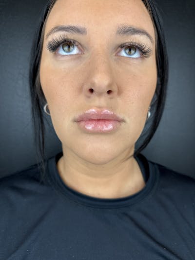 Lip Filler Before & After Gallery - Patient 254539 - Image 2