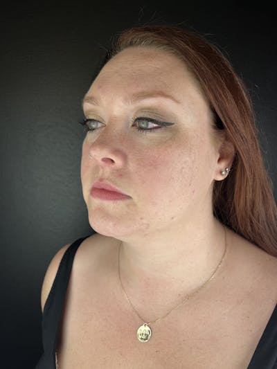 Lip Filler Before & After Gallery - Patient 106032 - Image 1