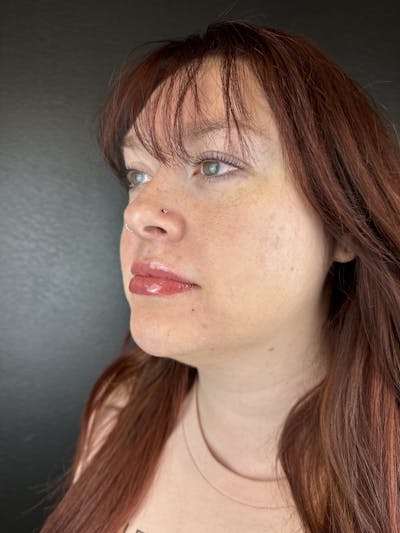 Lip Filler Before & After Gallery - Patient 106032 - Image 2
