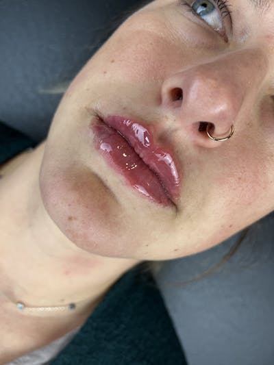 Lip Filler Before & After Gallery - Patient 174751 - Image 2
