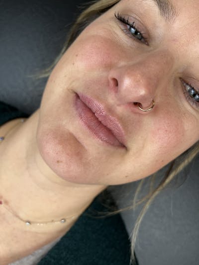 Lip Filler Before & After Gallery - Patient 174751 - Image 1