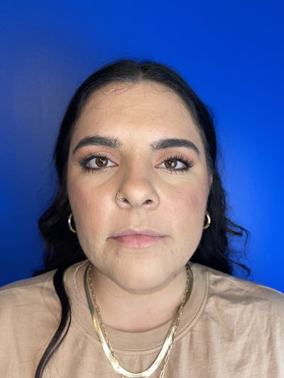 Lip Filler Before & After Gallery - Patient 379289 - Image 1