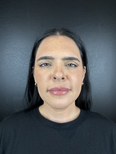 Lip Filler Before & After Gallery - Patient 379289 - Image 2