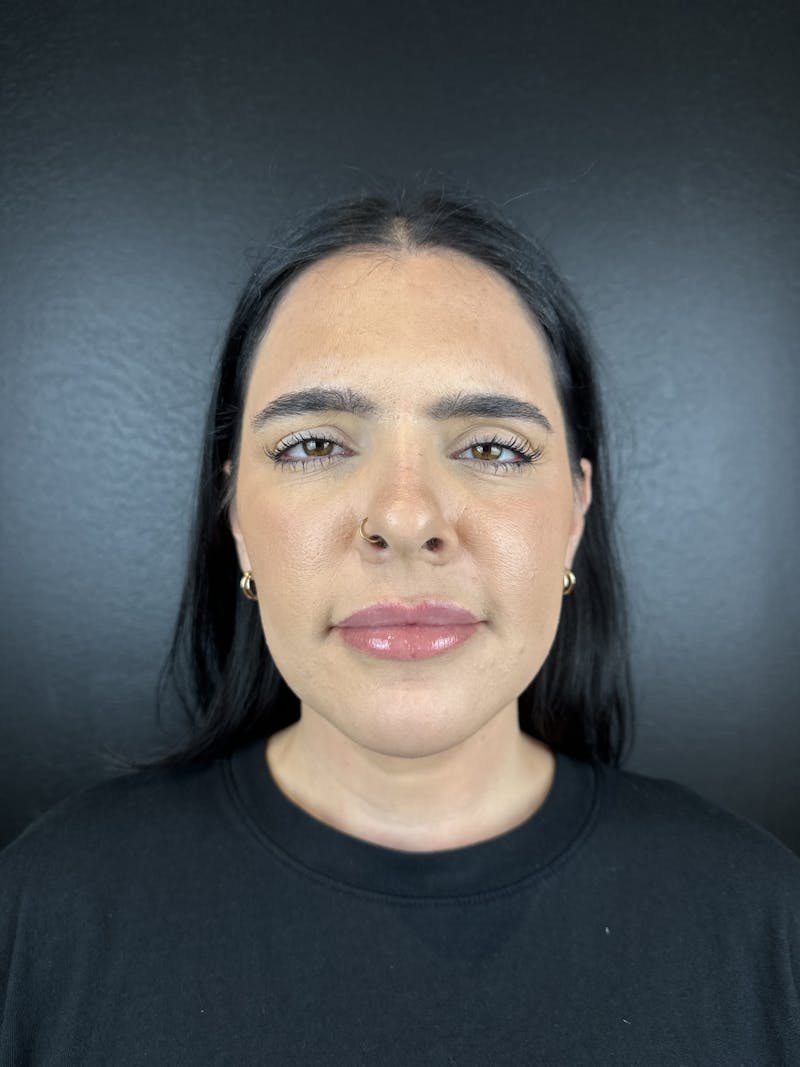 Lip Filler Before & After Gallery - Patient 379289 - Image 2