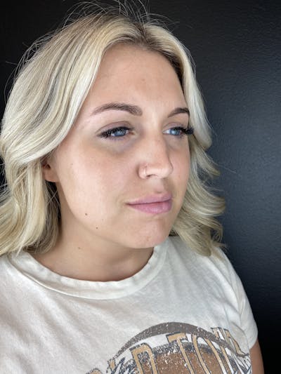 Lip Filler Before & After Gallery - Patient 260029 - Image 1