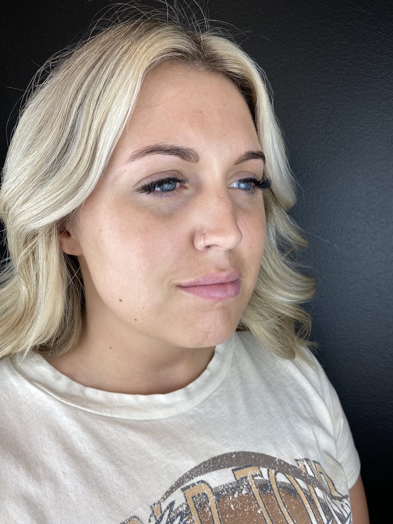 Lip Filler Before & After Gallery - Patient 260029 - Image 1