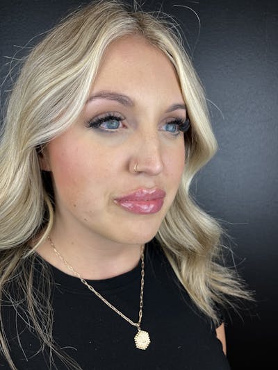 Lip Filler Before & After Gallery - Patient 260029 - Image 2