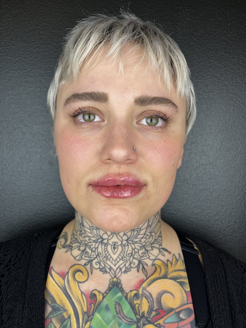 Lip Filler Before & After Gallery - Patient 201234 - Image 2