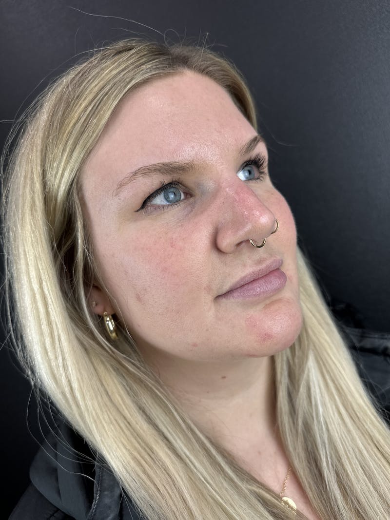 Lip Filler Before & After Gallery - Patient 372250 - Image 1