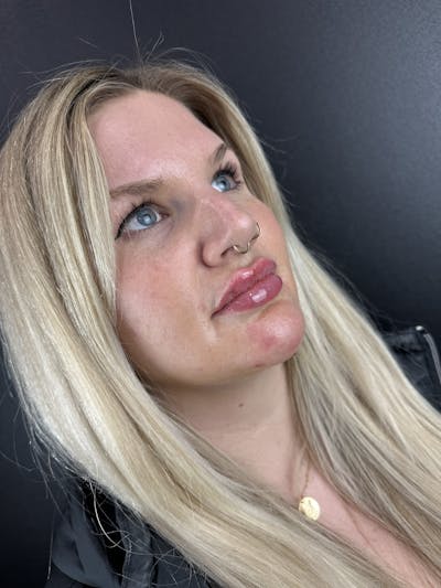 Lip Filler Before & After Gallery - Patient 372250 - Image 2