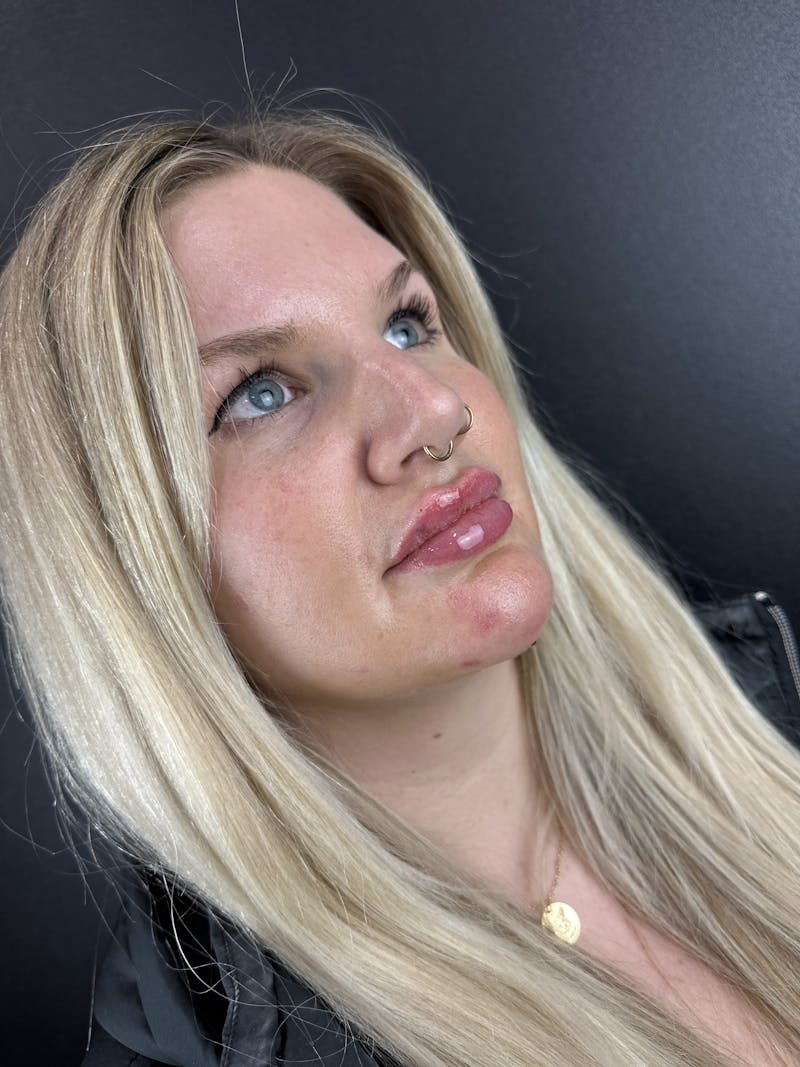 Lip Filler Before & After Gallery - Patient 372250 - Image 2