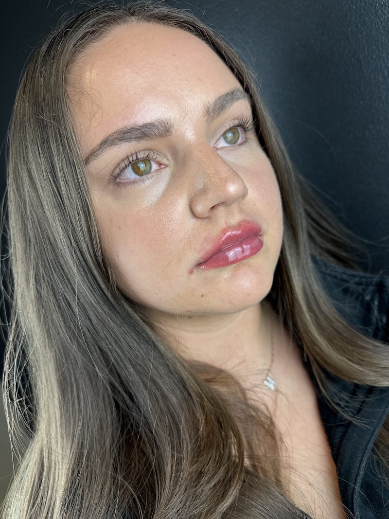 Lip Filler Before & After Gallery - Patient 332389 - Image 2