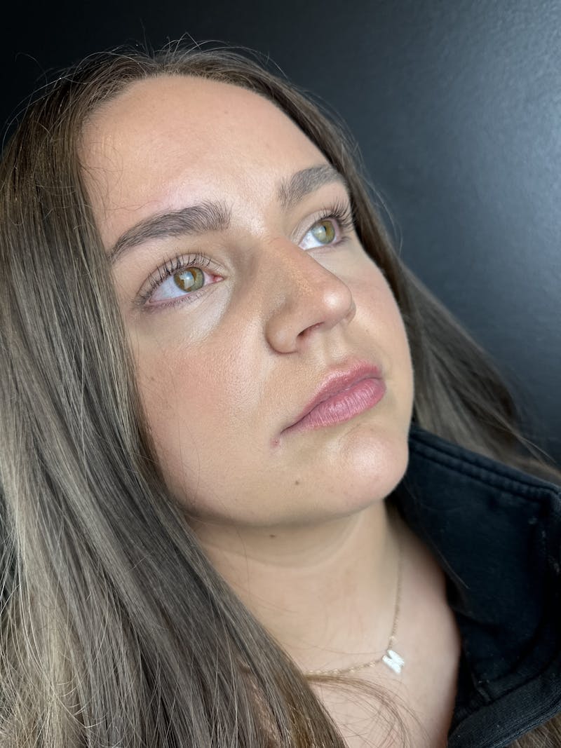 Lip Filler Before & After Gallery - Patient 332389 - Image 1