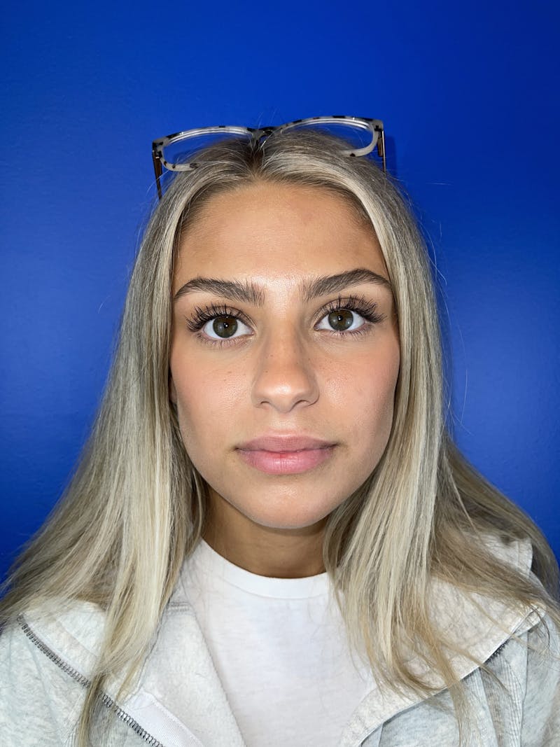 Lip Filler Before & After Gallery - Patient 250599 - Image 1