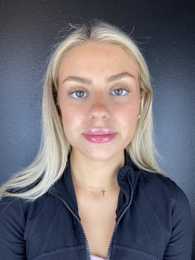 Lip Filler Before & After Gallery - Patient 250599 - Image 2