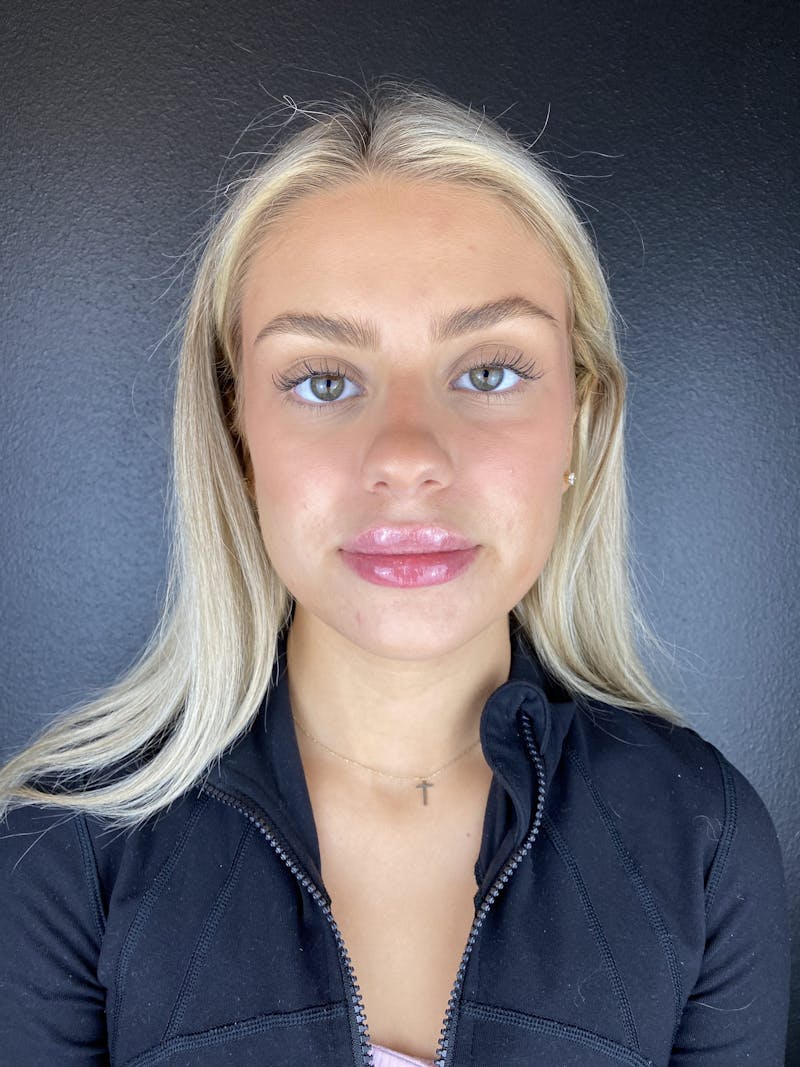Lip Filler Before & After Gallery - Patient 250599 - Image 2