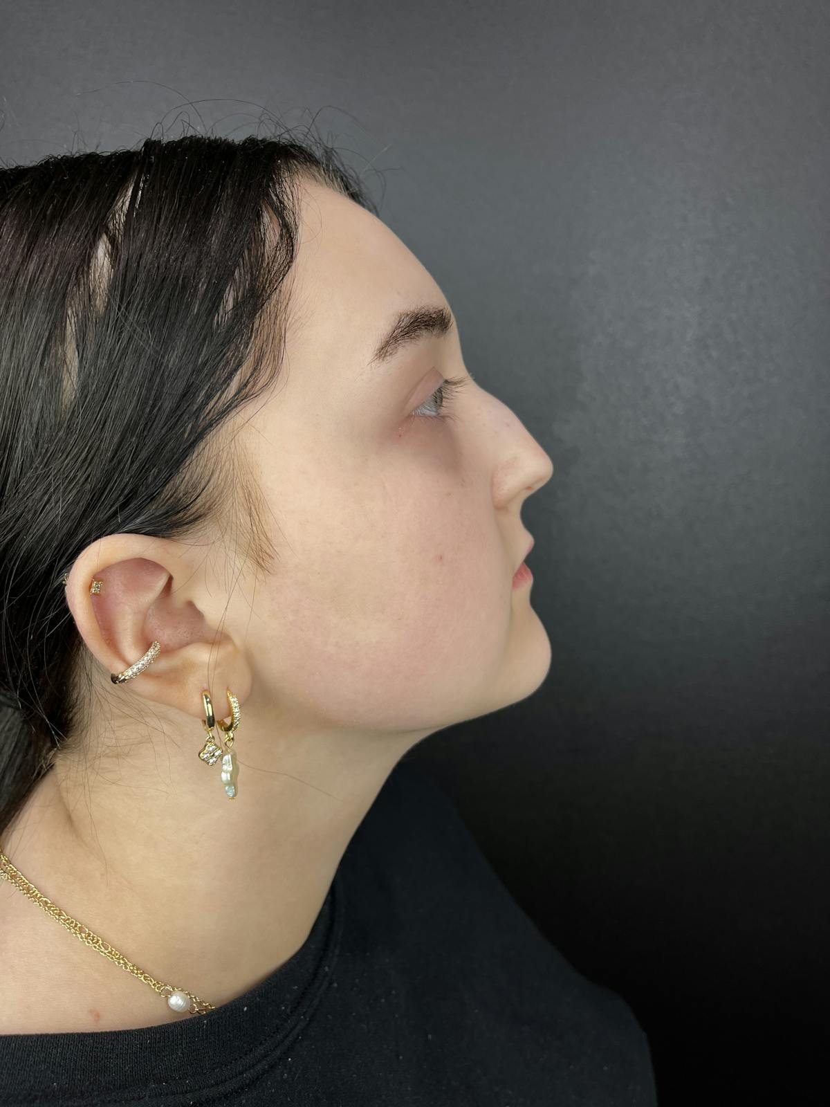 Liquid Rhinoplasty Before & After Gallery - Patient 103730 - Image 1