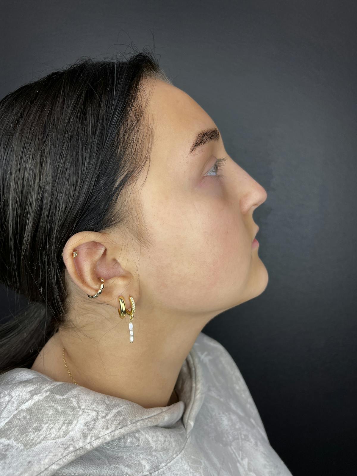 Liquid Rhinoplasty Before & After Gallery - Patient 103730 - Image 2
