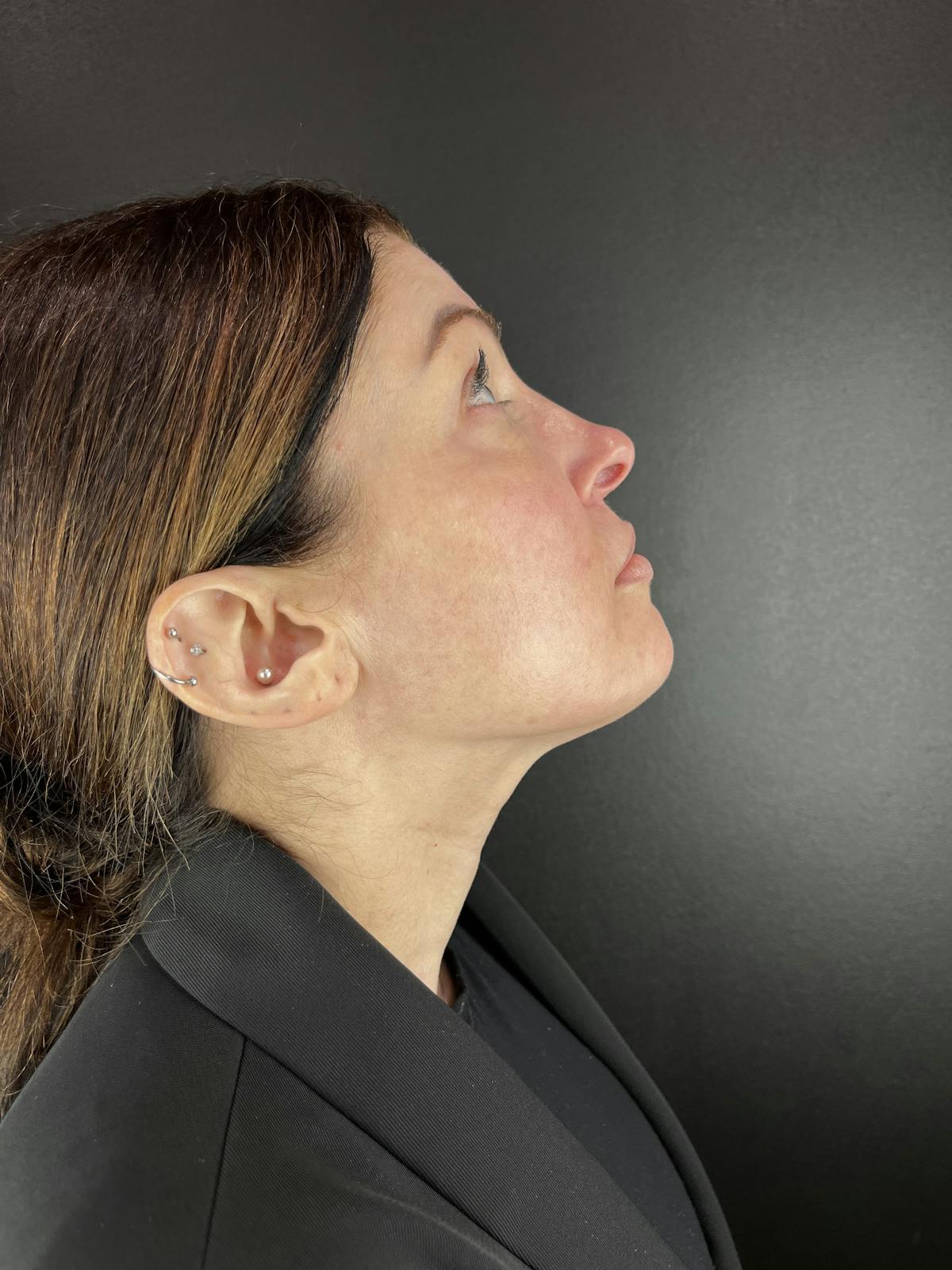 Liquid Rhinoplasty Before & After Gallery - Patient 552824 - Image 2