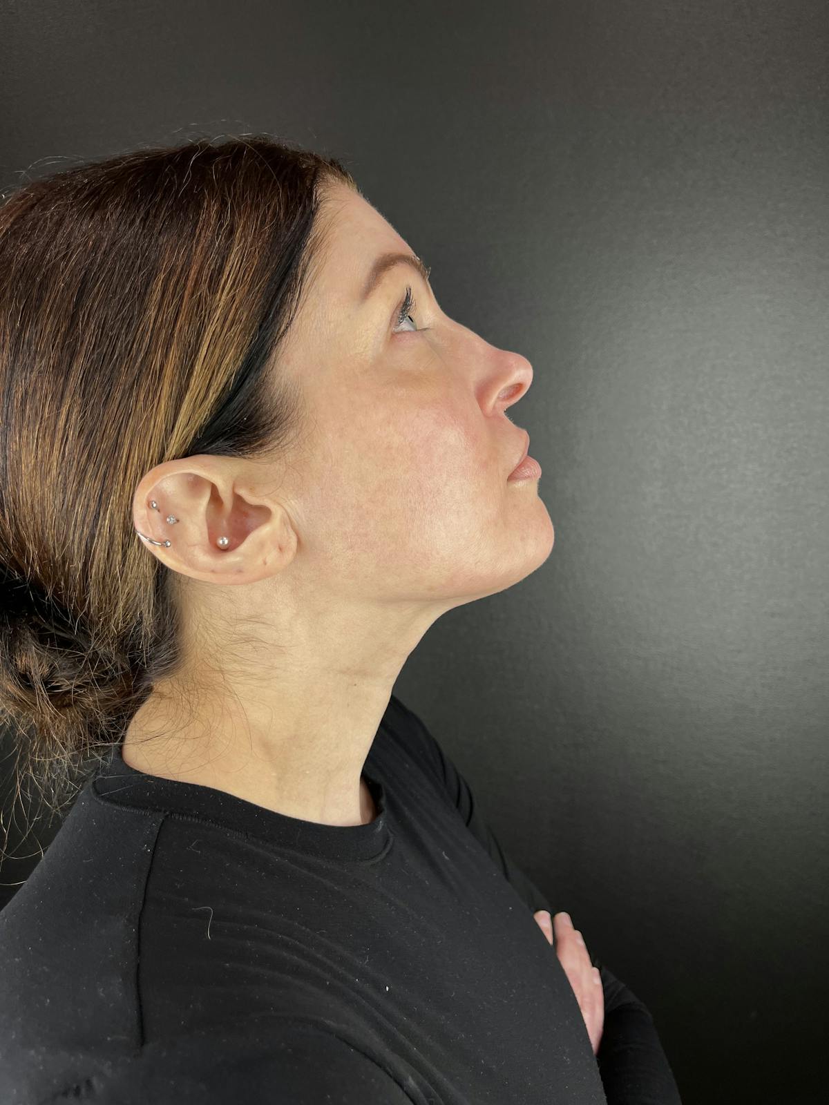 Liquid Rhinoplasty Before & After Gallery - Patient 552824 - Image 1