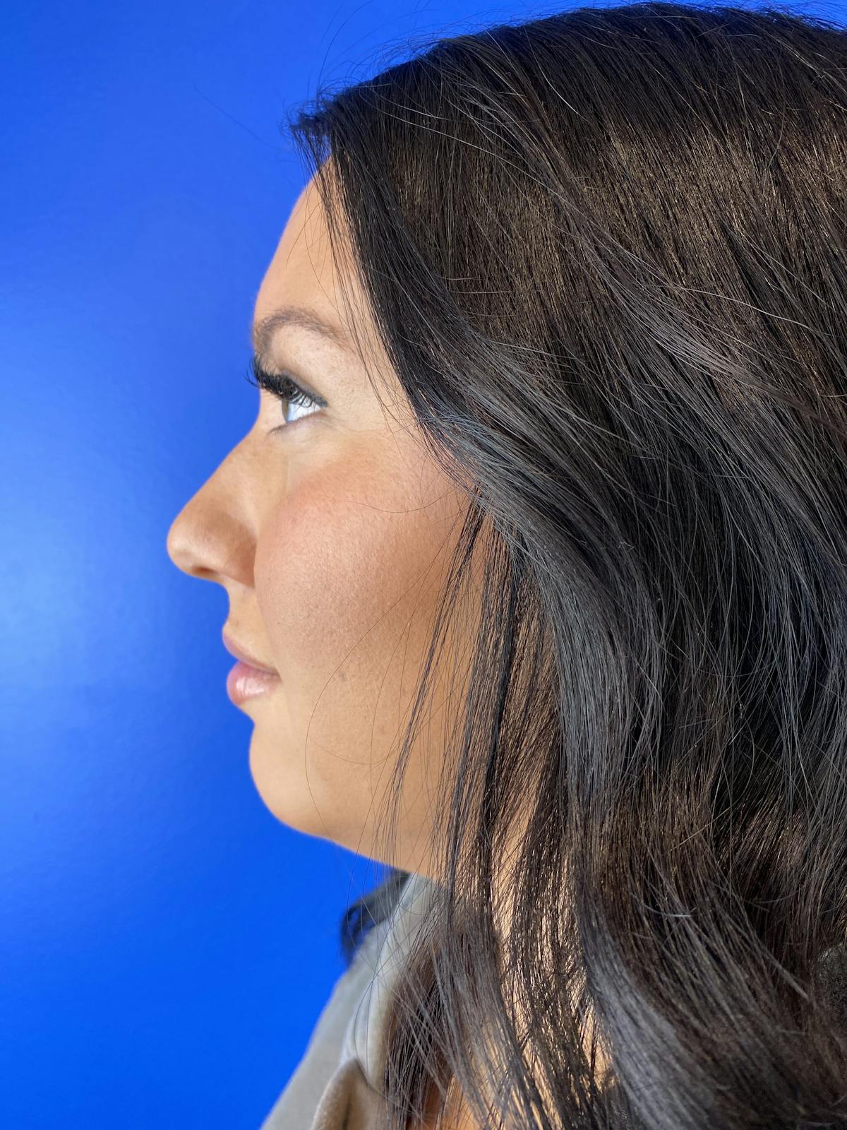 Liquid Rhinoplasty Before & After Gallery - Patient 288829 - Image 1