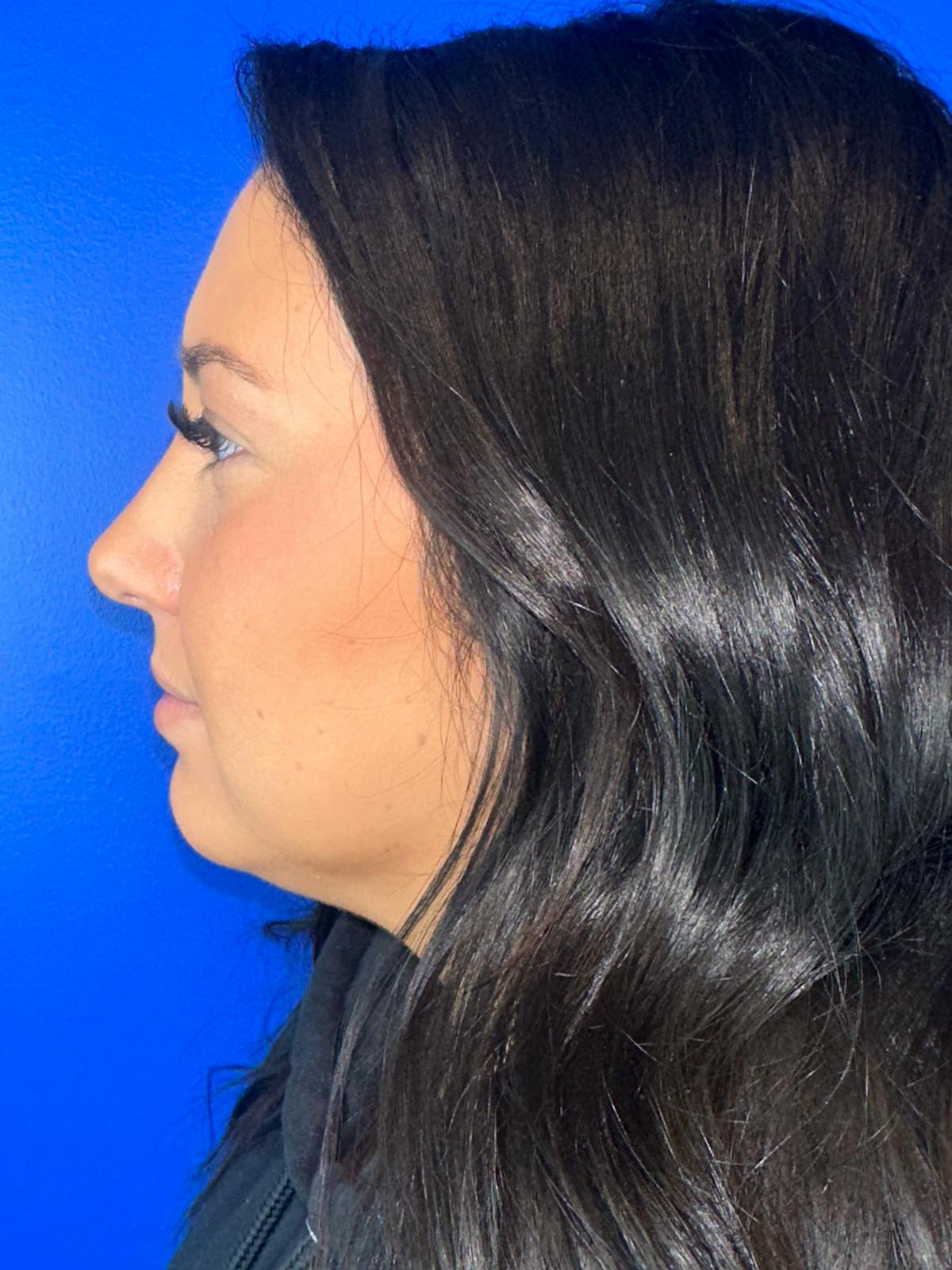 Liquid Rhinoplasty Before & After Gallery - Patient 288829 - Image 2