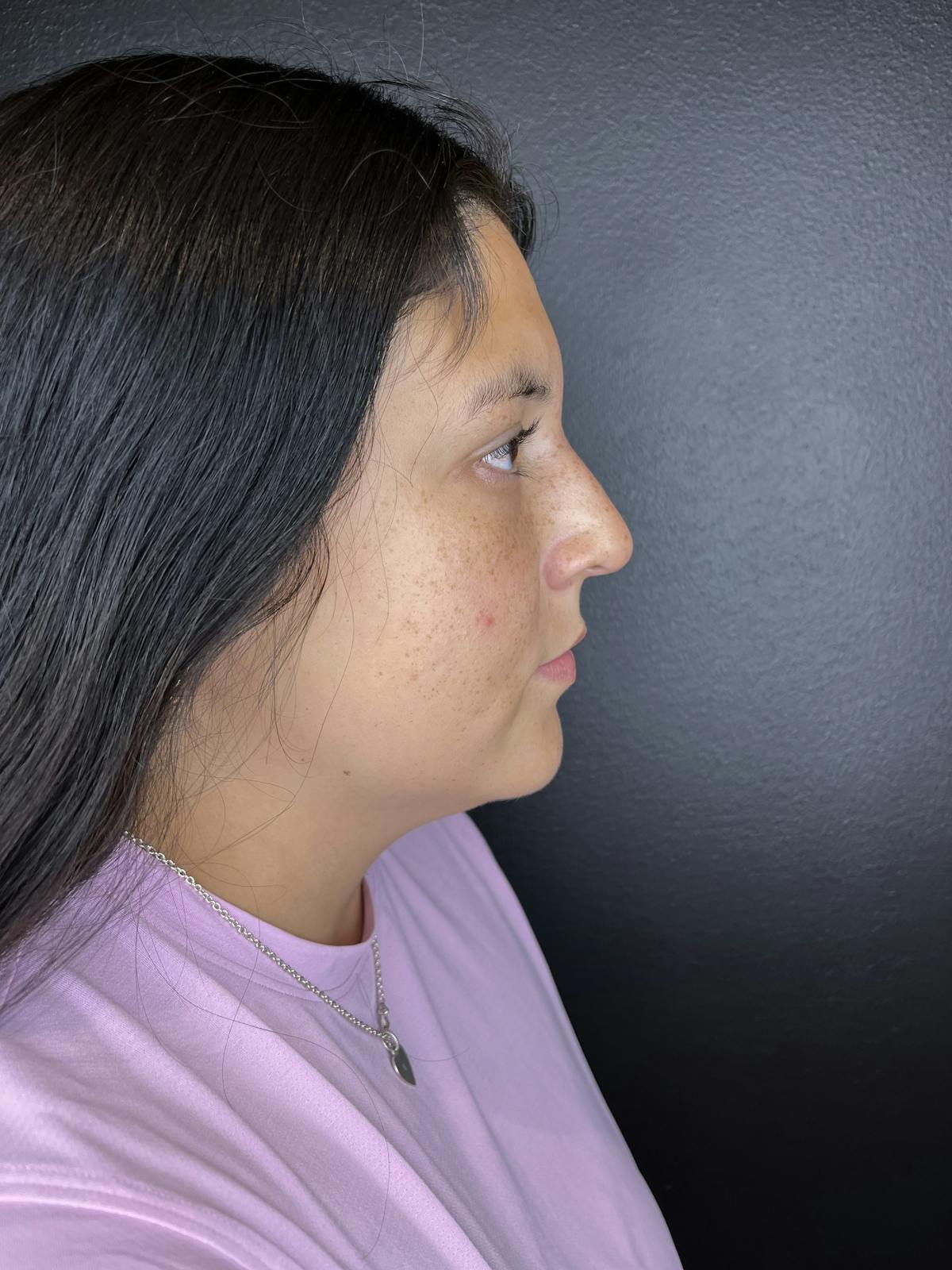 Liquid Rhinoplasty Before & After Gallery - Patient 412426 - Image 2