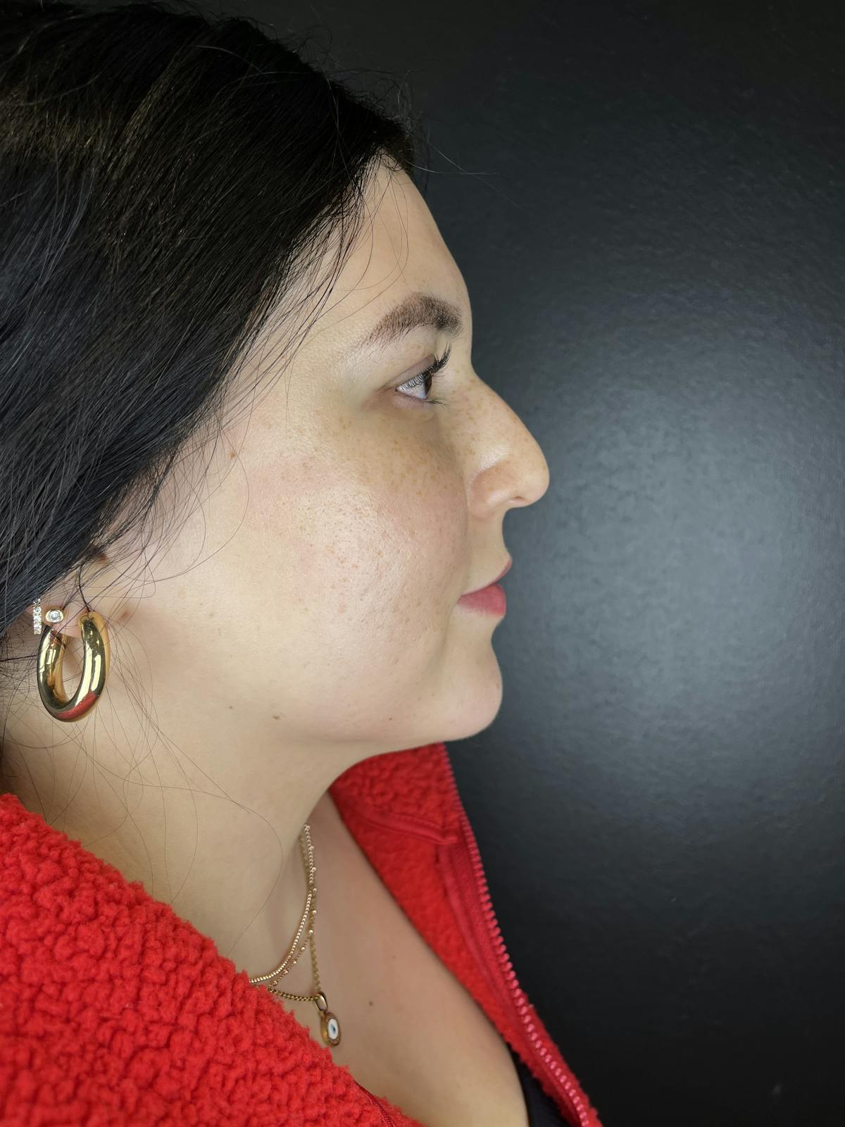 Liquid Rhinoplasty Before & After Gallery - Patient 412426 - Image 1
