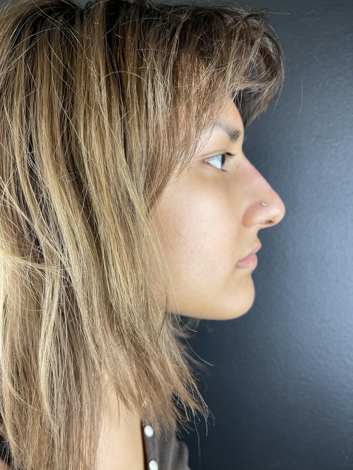 Liquid Rhinoplasty Before & After Gallery - Patient 361577 - Image 2