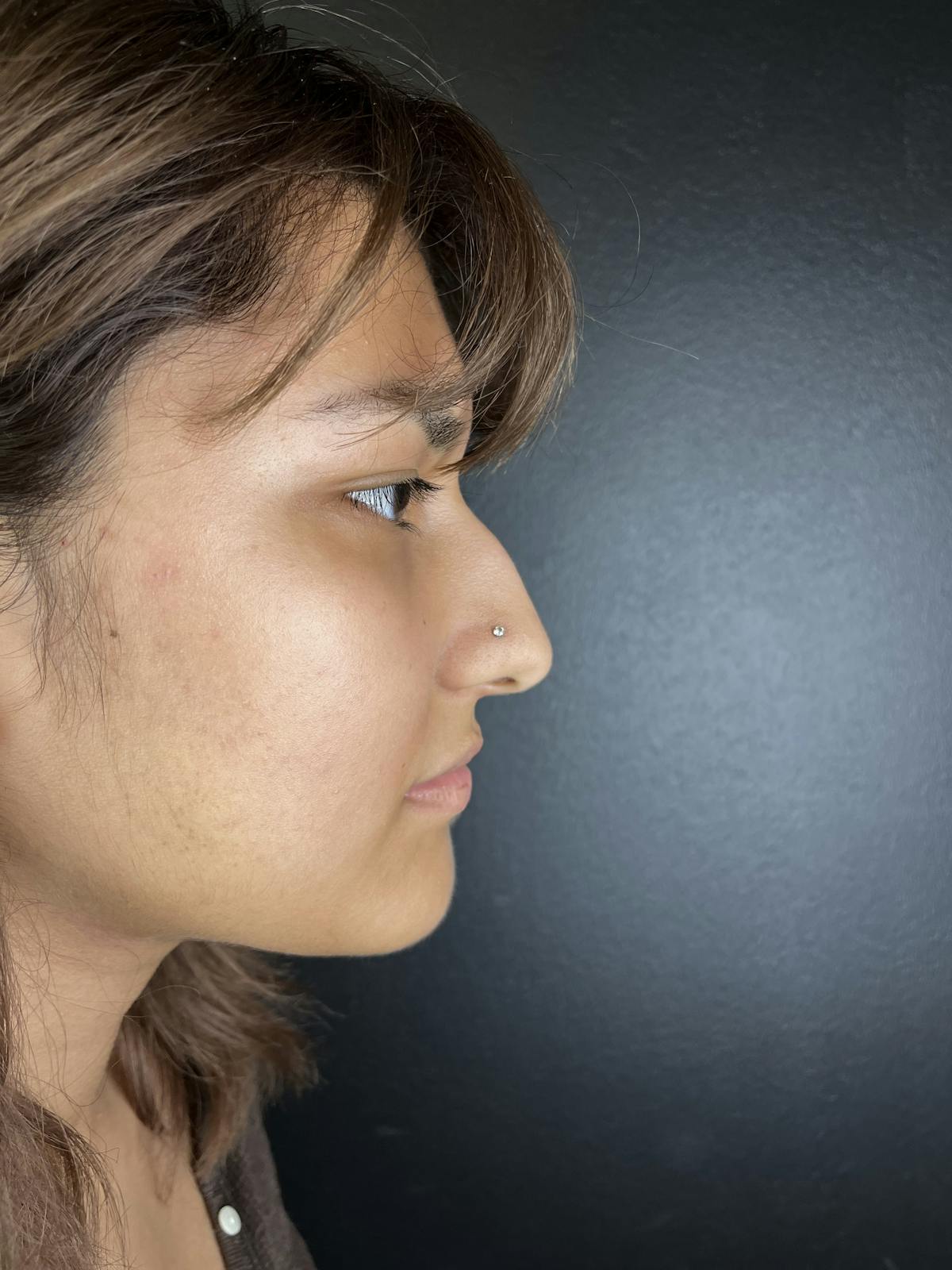 Liquid Rhinoplasty Before & After Gallery - Patient 361577 - Image 1