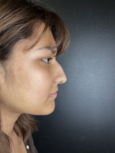 Liquid Rhinoplasty Before & After Gallery - Patient 361577 - Image 1