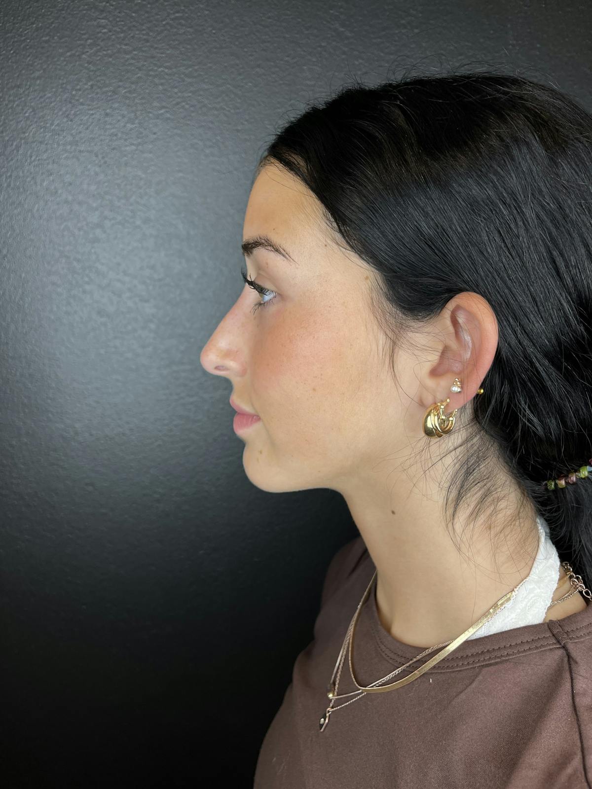 Liquid Rhinoplasty Before & After Gallery - Patient 127593 - Image 2