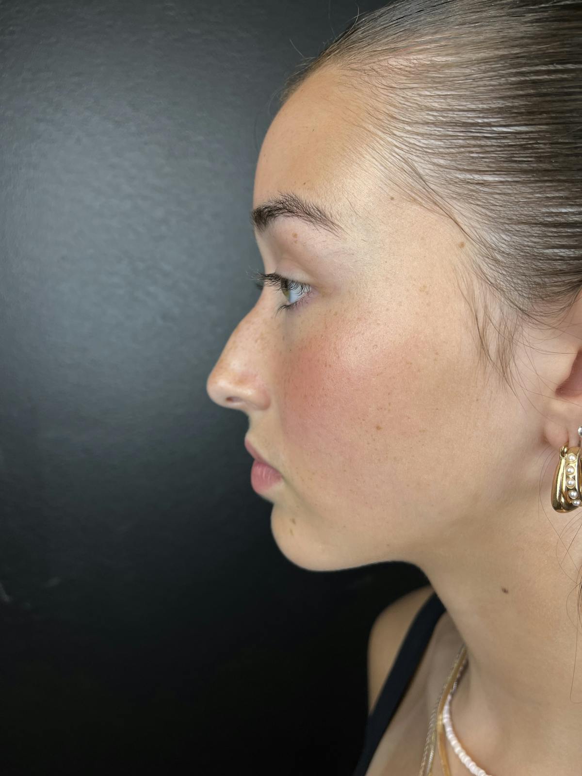 Liquid Rhinoplasty Before & After Gallery - Patient 127593 - Image 1