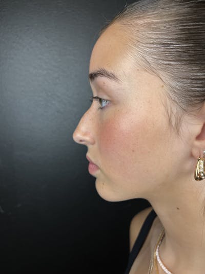 Liquid Rhinoplasty Before & After Gallery - Patient 127593 - Image 1