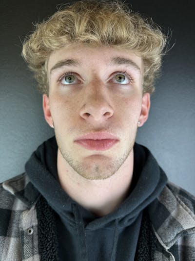 Chin Filler Before & After Gallery - Patient 496980 - Image 2