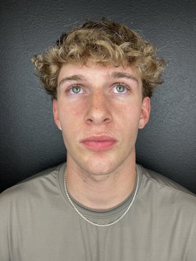 Chin Filler Before & After Gallery - Patient 496980 - Image 1