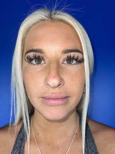 Chin Filler Before & After Gallery - Patient 111494 - Image 1
