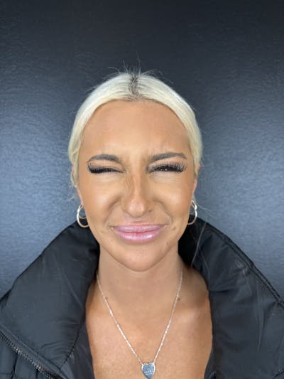 Chin Filler Before & After Gallery - Patient 111494 - Image 2