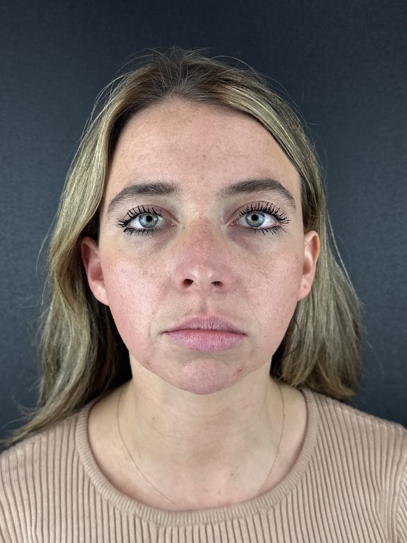 Chin Filler Before & After Gallery - Patient 209240 - Image 3
