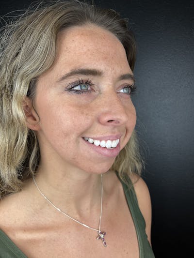 Chin Filler Before & After Gallery - Patient 209240 - Image 1