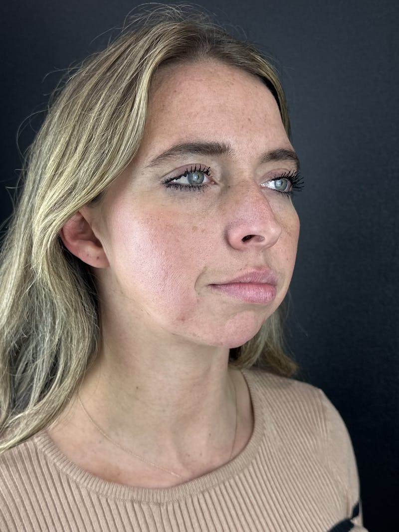 Chin Filler Before & After Gallery - Patient 209240 - Image 5